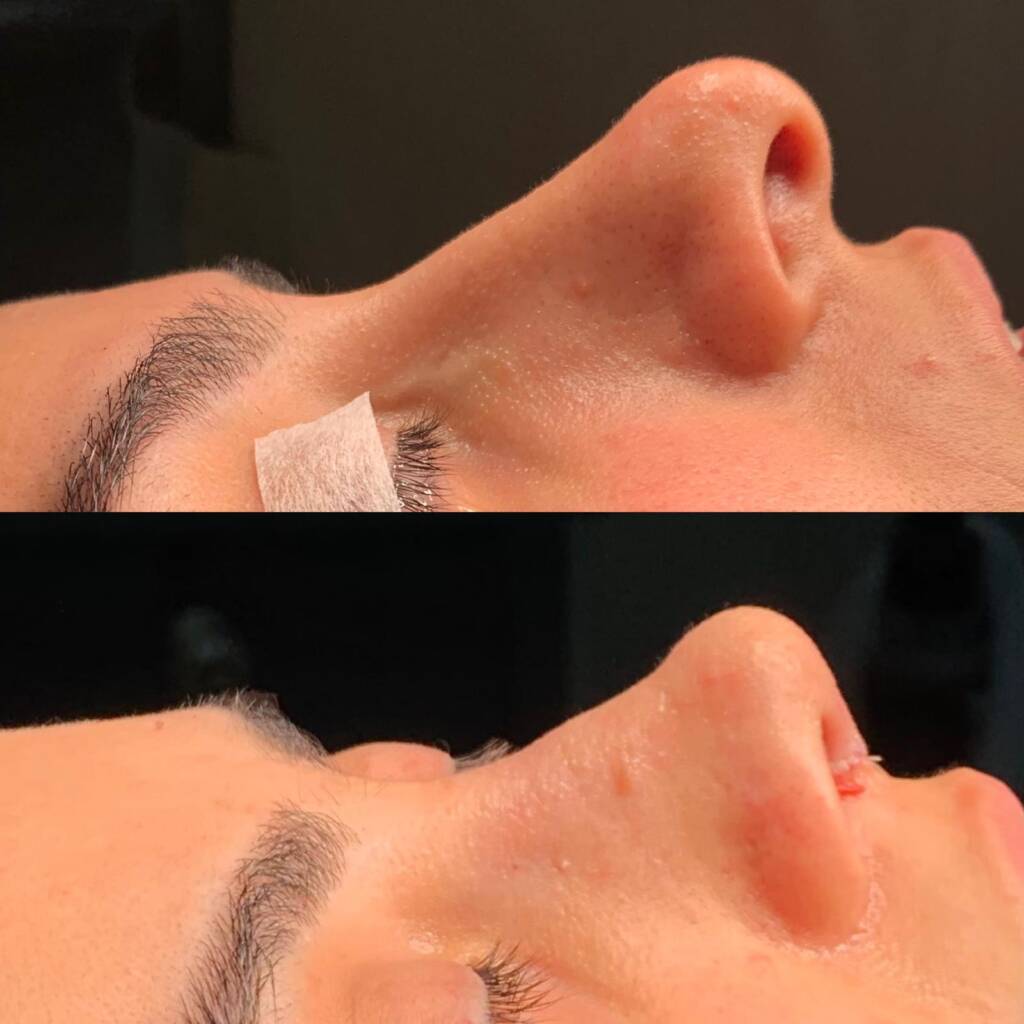 US Patients' 2026 Guide: Rhinoplasty in Istanbul, Turkey - Görsel 13 - Prof. Dr. Baki Yılmaz