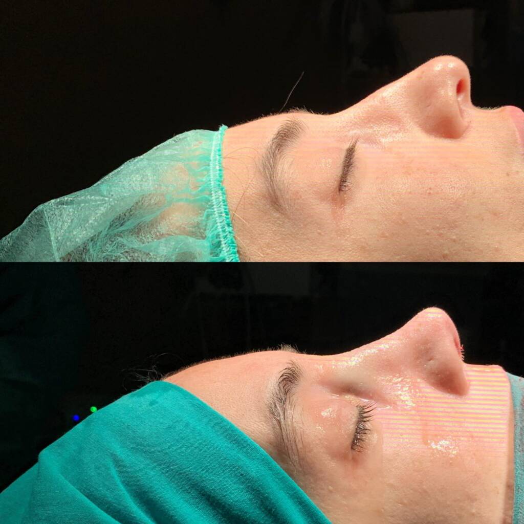 Top 7 Reasons to Get an Affordable Nose Job in Istanbul - Görsel 11 - Prof. Dr. Baki Yılmaz