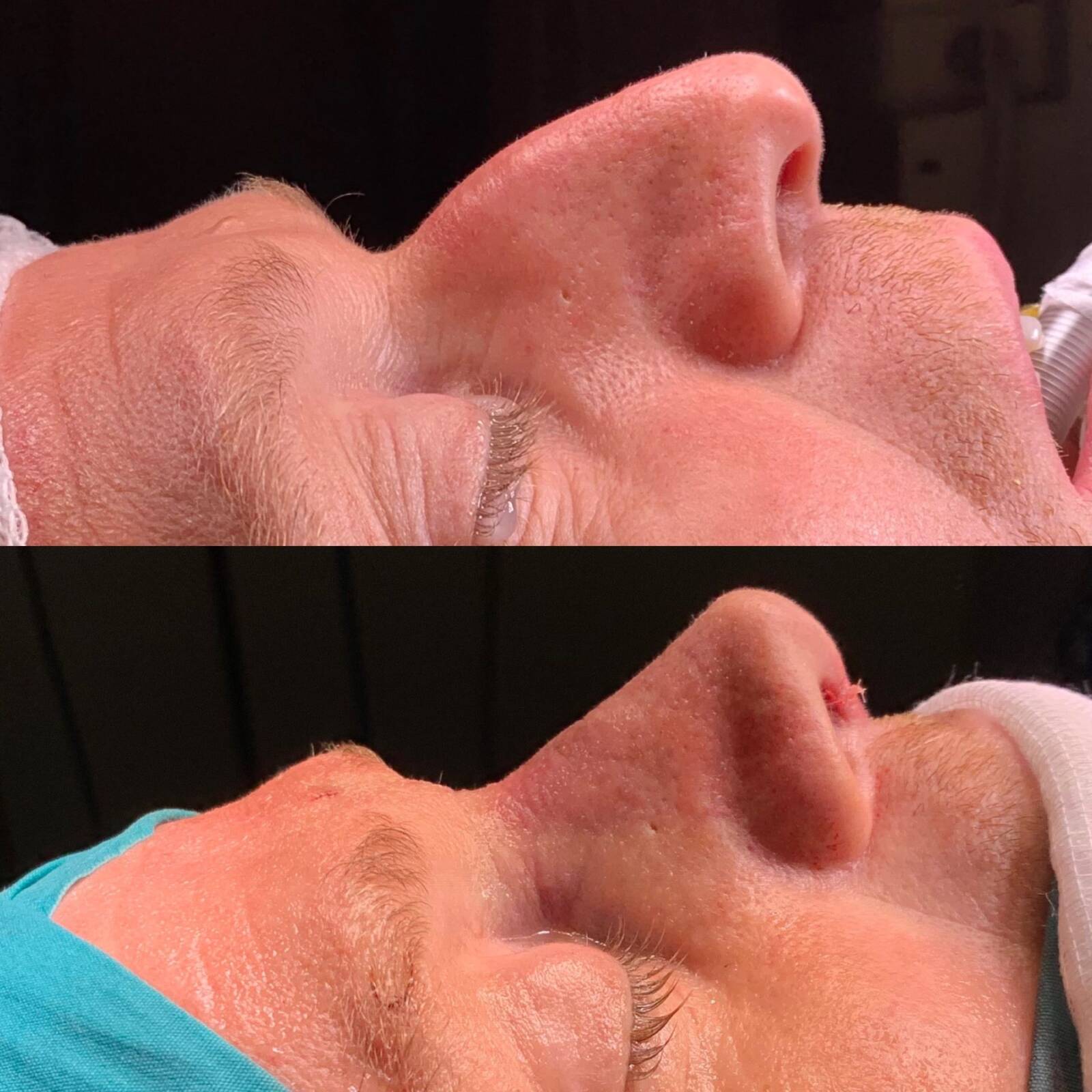 Straight nose rhinoplasty Istanbul