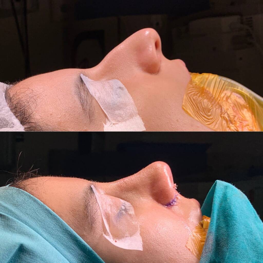 Ist eine zweite Nasenkorrektur sicher? Revision Rhinoplastik in Istanbul erklärt - Görsel 12 - Prof. Dr. Baki Yılmaz