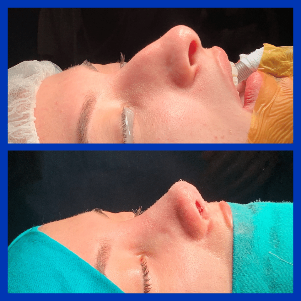 5 Gründe, warum Deutsche Patienten Non-Surgical Rhinoplasty in Istanbul wählen 2026 - Görsel 6 - Prof. Dr. Baki Yılmaz