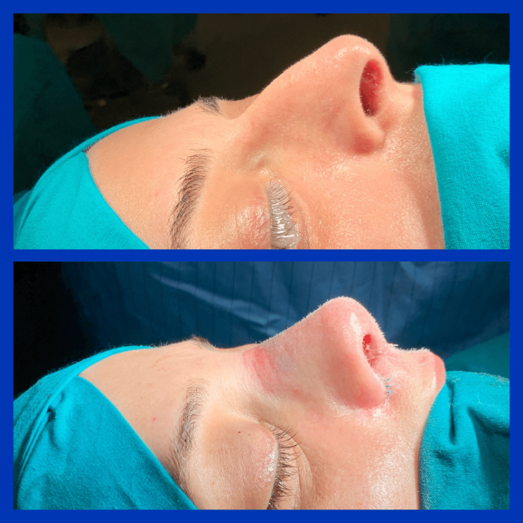 Affordable (Nose Job) Revision Rhinoplasty in Turkey 2026 - Görsel 6 - Prof. Dr. Baki Yılmaz
