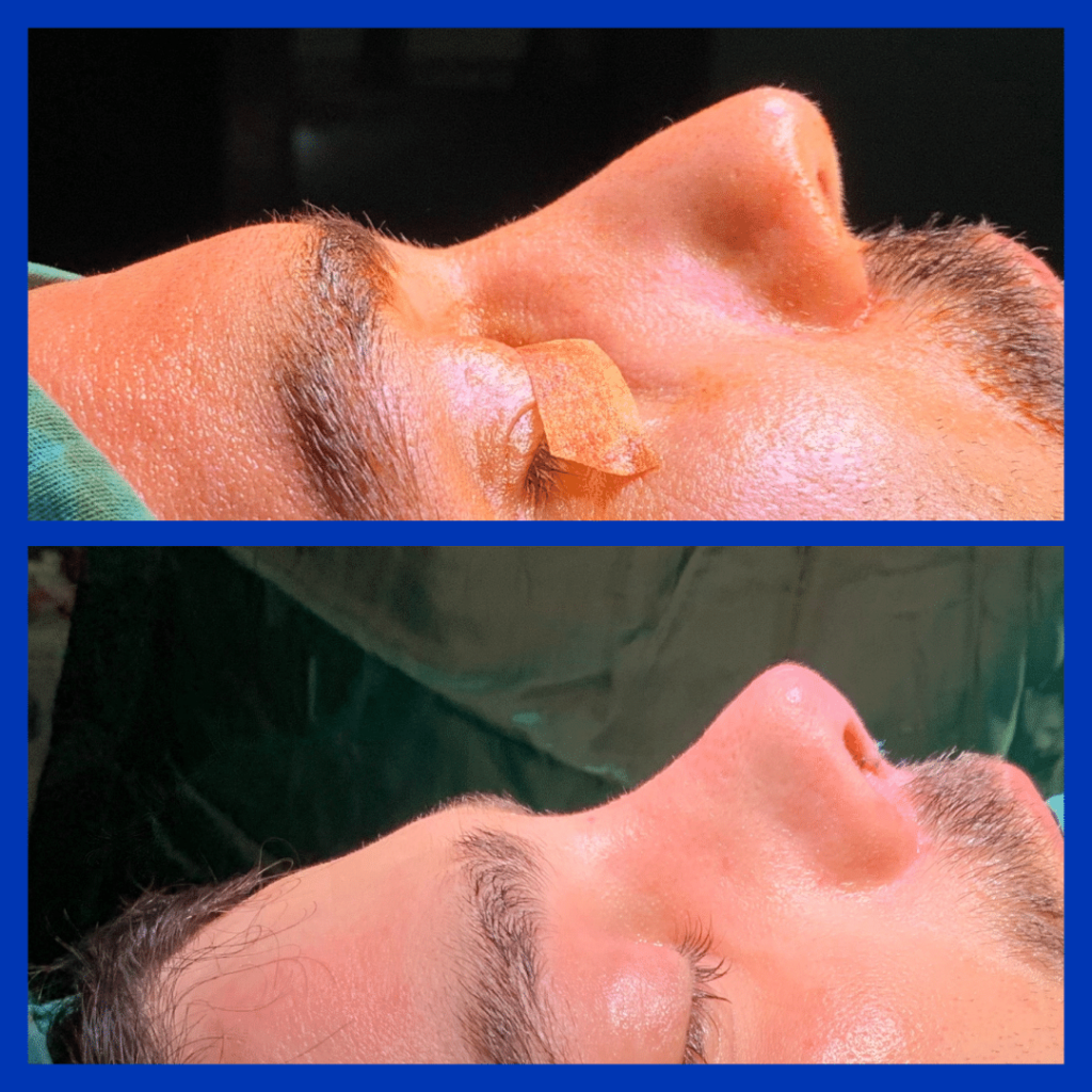 5 Gründe, warum Deutsche Patienten Non-Surgical Rhinoplasty in Istanbul wählen 2026 - Görsel 5 - Prof. Dr. Baki Yılmaz