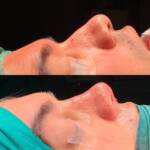 Revision Rhinoplasty in Turkey: Nose Job Surgery Turkey, Istanbul 2025 - Görsel 7 - Prof. Dr. Baki Yılmaz