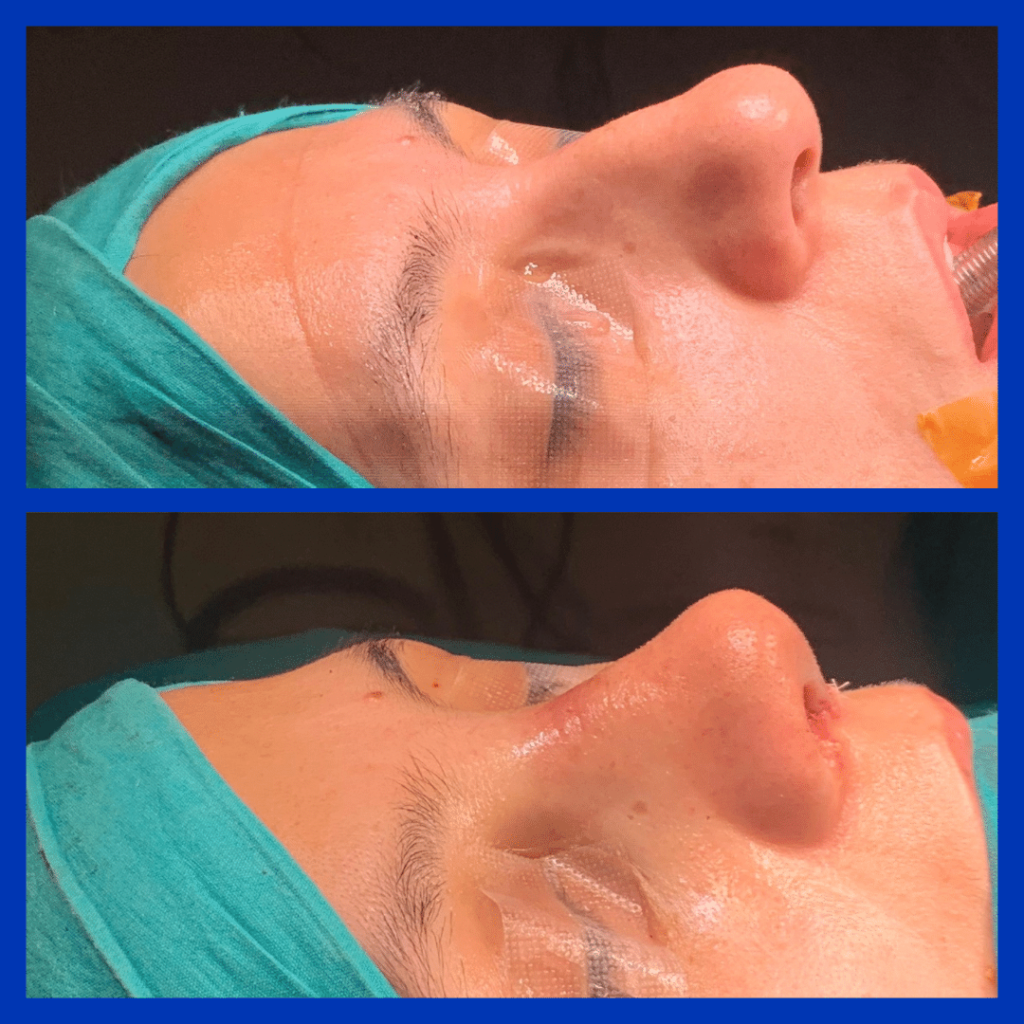 Septoplasty vs Rhinoplasty: Functional vs Aesthetic? [2026 Expert Guide] - Görsel 10 - Prof. Dr. Baki Yılmaz