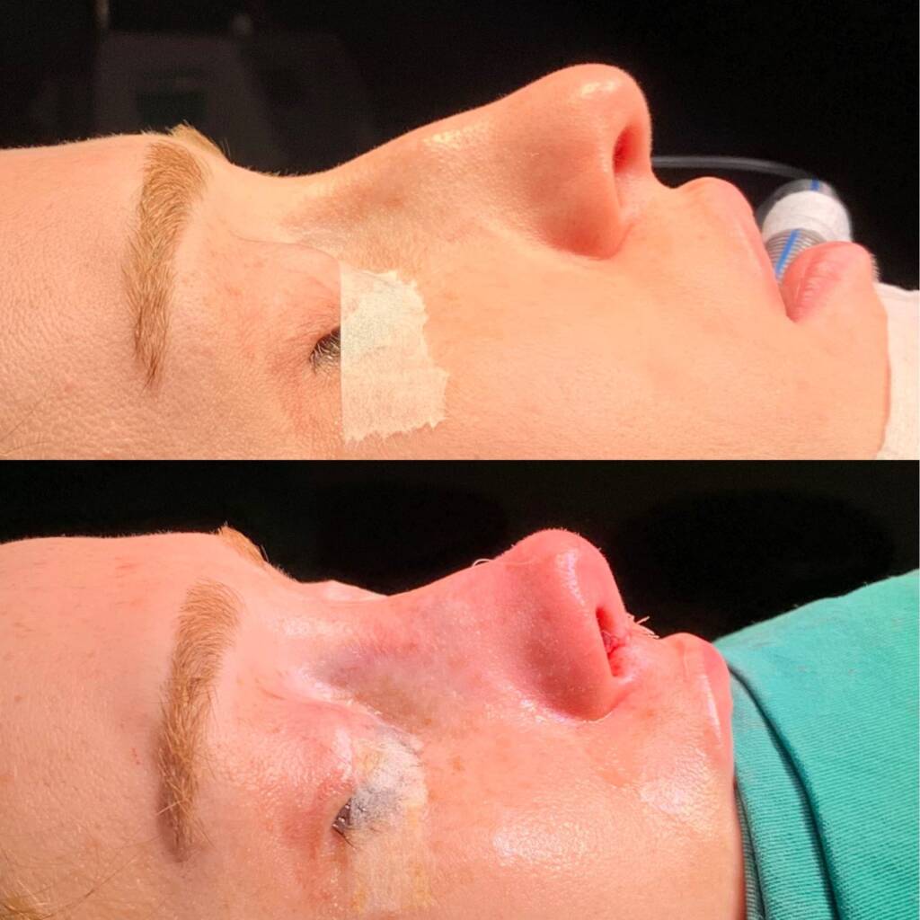 Septoplasty vs Rhinoplasty: Functional vs Aesthetic? [2026 Expert Guide] - Görsel 9 - Prof. Dr. Baki Yılmaz
