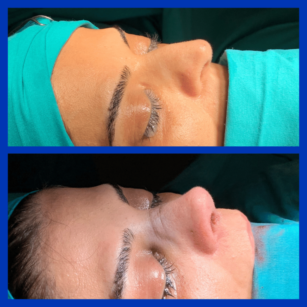 Ultrasonic Rhinoplasty in Turkey: The Ultimate 2025 Guide for US Patients - Görsel 7 - Prof. Dr. Baki Yılmaz