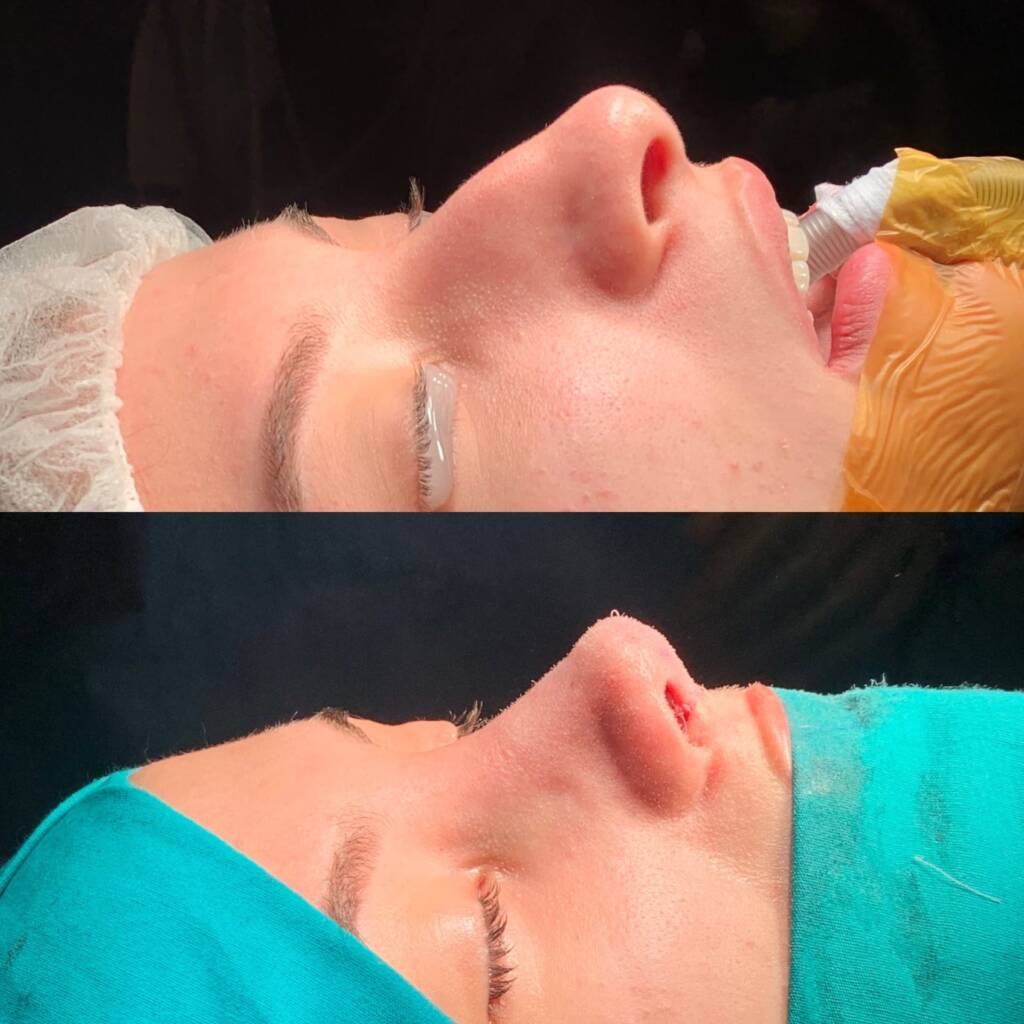 Ist eine zweite Nasenkorrektur sicher? Revision Rhinoplastik in Istanbul erklärt - Görsel 6 - Prof. Dr. Baki Yılmaz