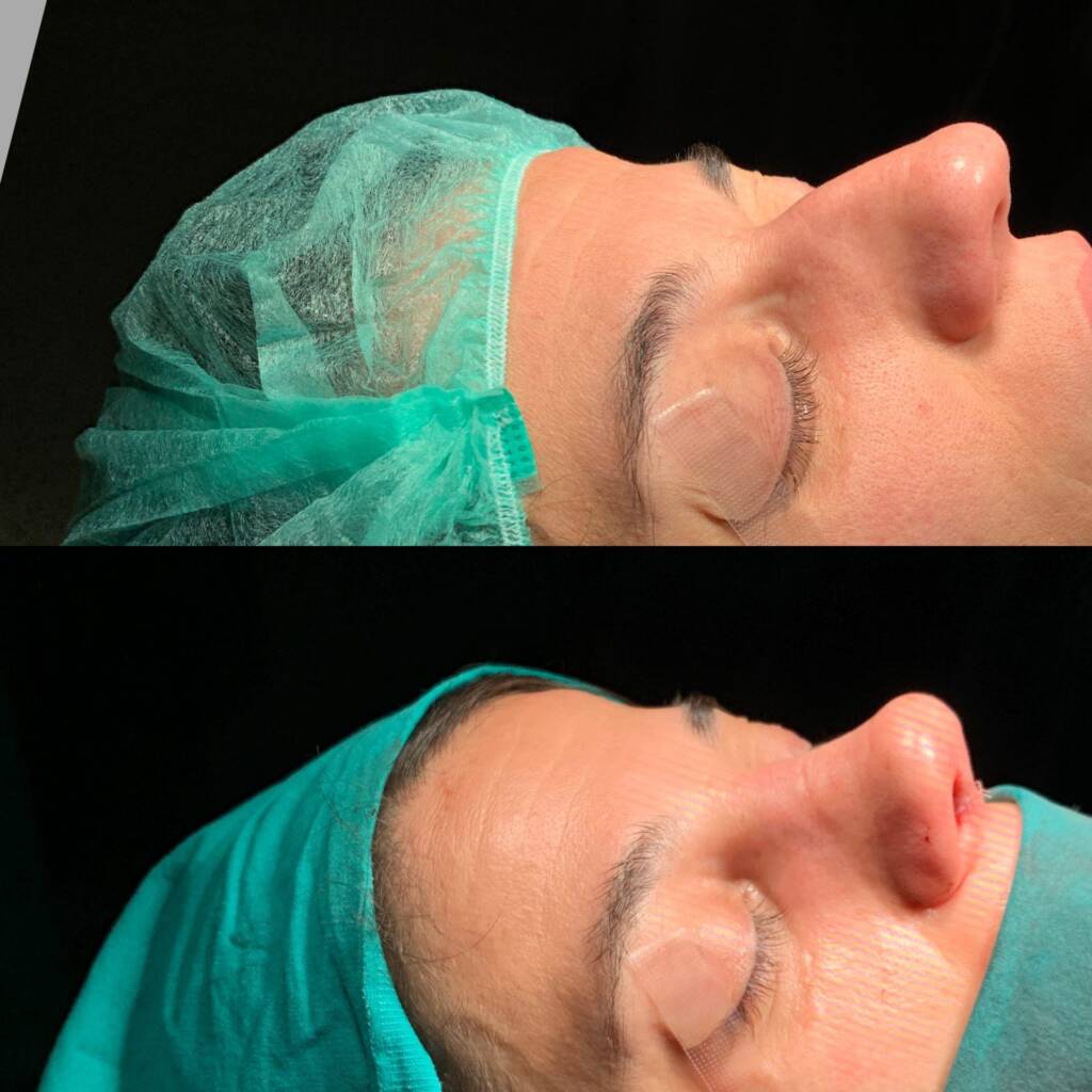 Natural Rhinoplasty in Istanbul – Achieve Subtle, Harmonious Results 2026 - Görsel 7 - Prof. Dr. Baki Yılmaz