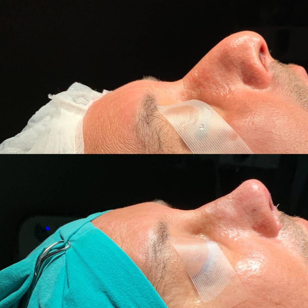 5 Gründe, warum Deutsche Patienten Non-Surgical Rhinoplasty in Istanbul wählen 2026 - Görsel 8 - Prof. Dr. Baki Yılmaz