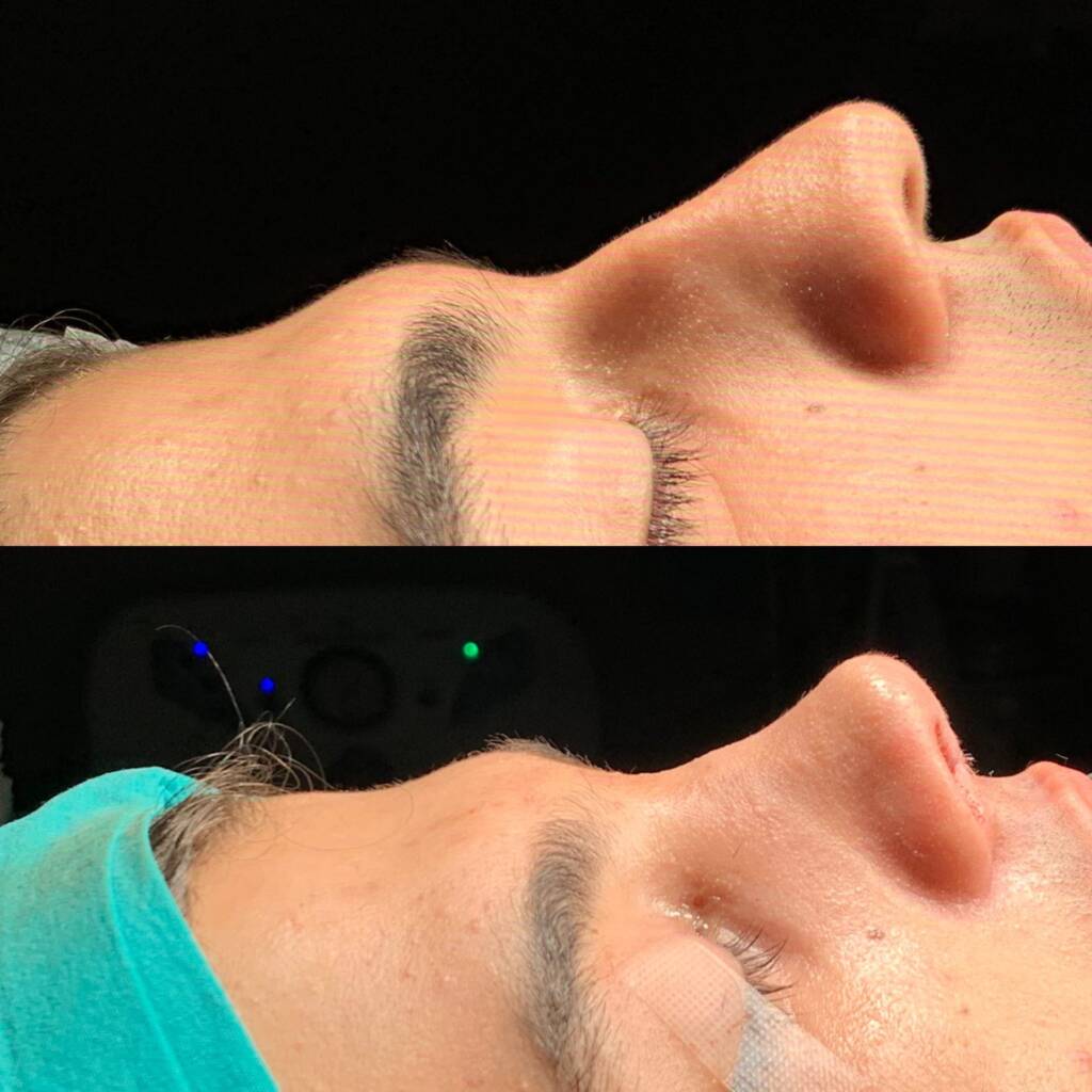 5 Gründe, warum Deutsche Patienten Non-Surgical Rhinoplasty in Istanbul wählen 2026 - Görsel 7 - Prof. Dr. Baki Yılmaz