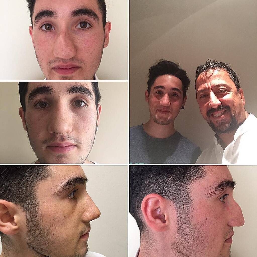 burun estetiği sonrası ay ay değişim, Rhinoplasty Swelling and Healing, male rhinoplasty, erkek burun estetiği