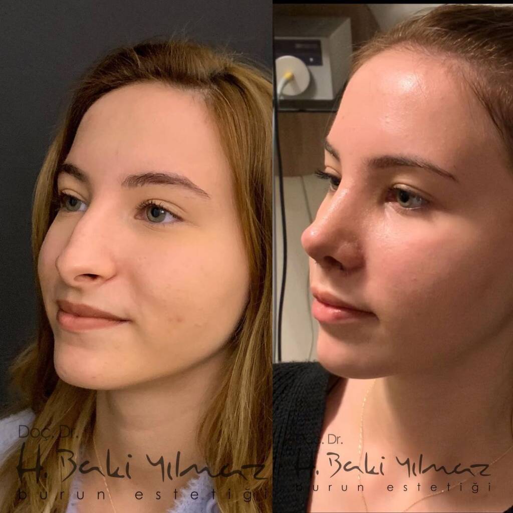rhinoplasty in turkey