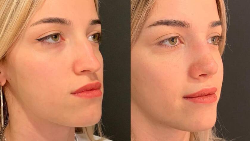 burun estetiği sonrası ay ay değişim, Rhinoplasty Swelling and Healing