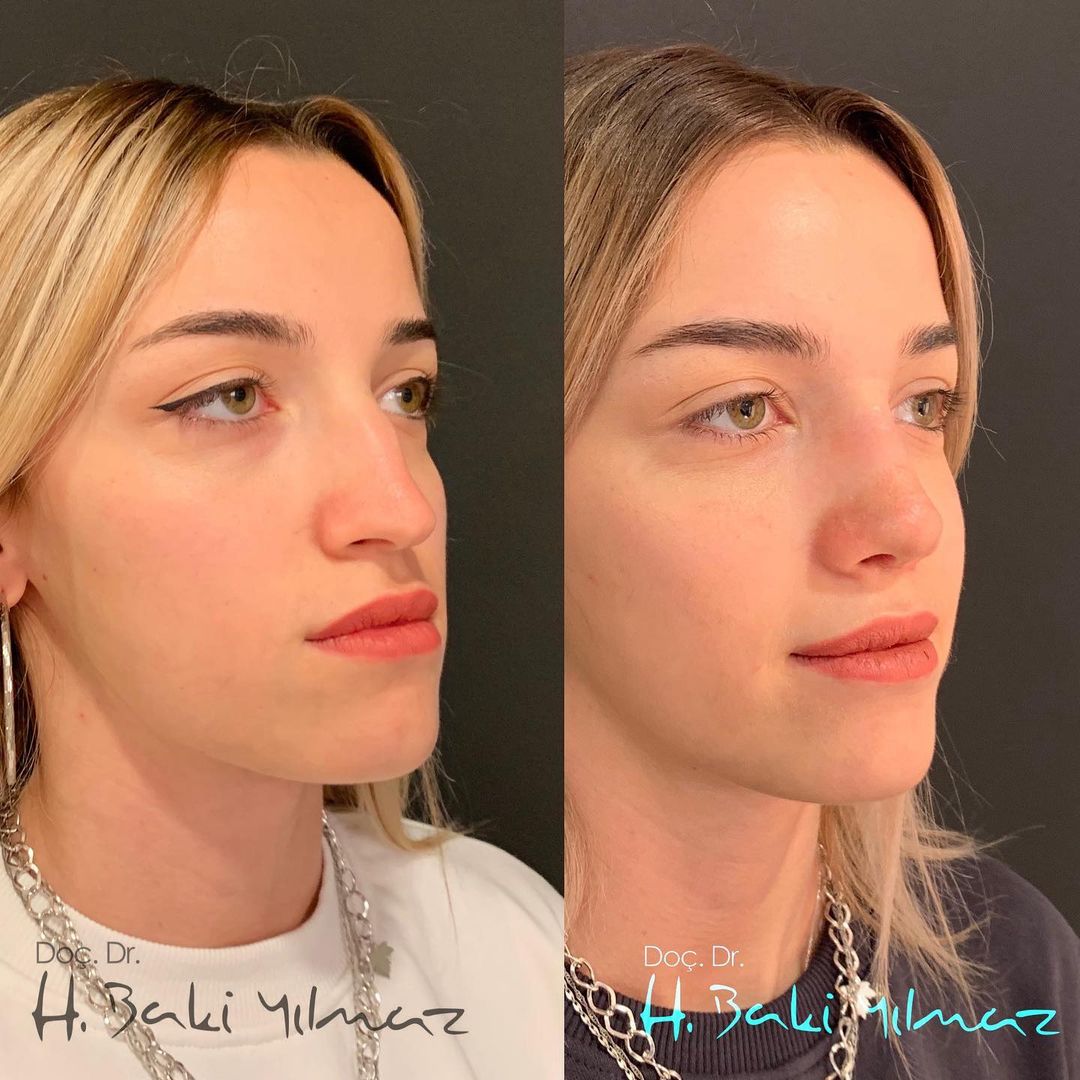 burun estetiği sonrası ay ay değişim, Rhinoplasty Swelling and Healing