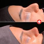Revision Rhinoplasty in Turkey: Nose Job Surgery Turkey, Istanbul 2025 - Prof. Dr. Baki Yılmaz