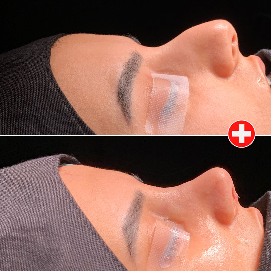 The Ultimate Rhinoplasty Healing Timeline: A Week-by-Week Guide - Görsel 4 - Prof. Dr. Baki Yılmaz