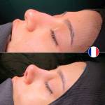 Revision Rhinoplasty in Turkey: Nose Job Surgery Turkey, Istanbul 2025 - Görsel 2 - Prof. Dr. Baki Yılmaz