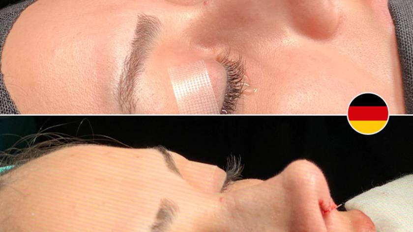 Vorher-Nachher Vergleich einer Nasenkorrektur (Rhinoplastik) im Seitenprofil. Das untere Bild zeigt das Ergebnis direkt nach der Operation mit sichtbaren Nähten. Patientin aus Deutschland. Dr. Baki Yılmaz