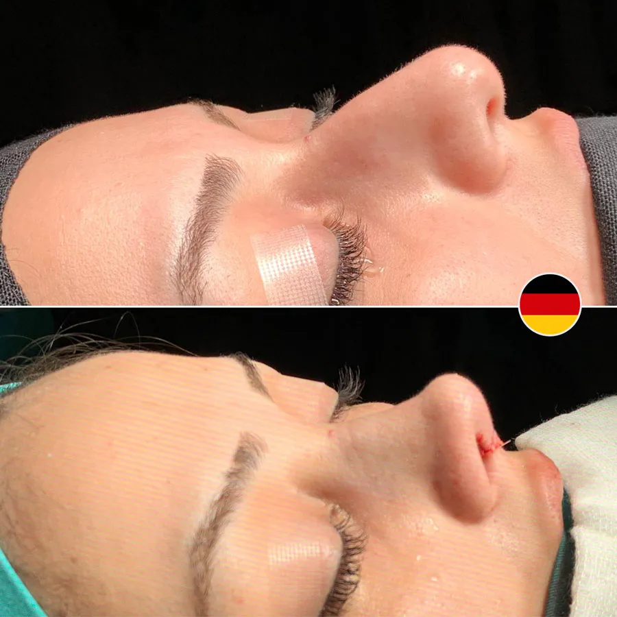 Vorher-Nachher Vergleich einer Nasenkorrektur (Rhinoplastik) im Seitenprofil. Das untere Bild zeigt das Ergebnis direkt nach der Operation mit sichtbaren Nähten. Patientin aus Deutschland. Dr. Baki Yılmaz