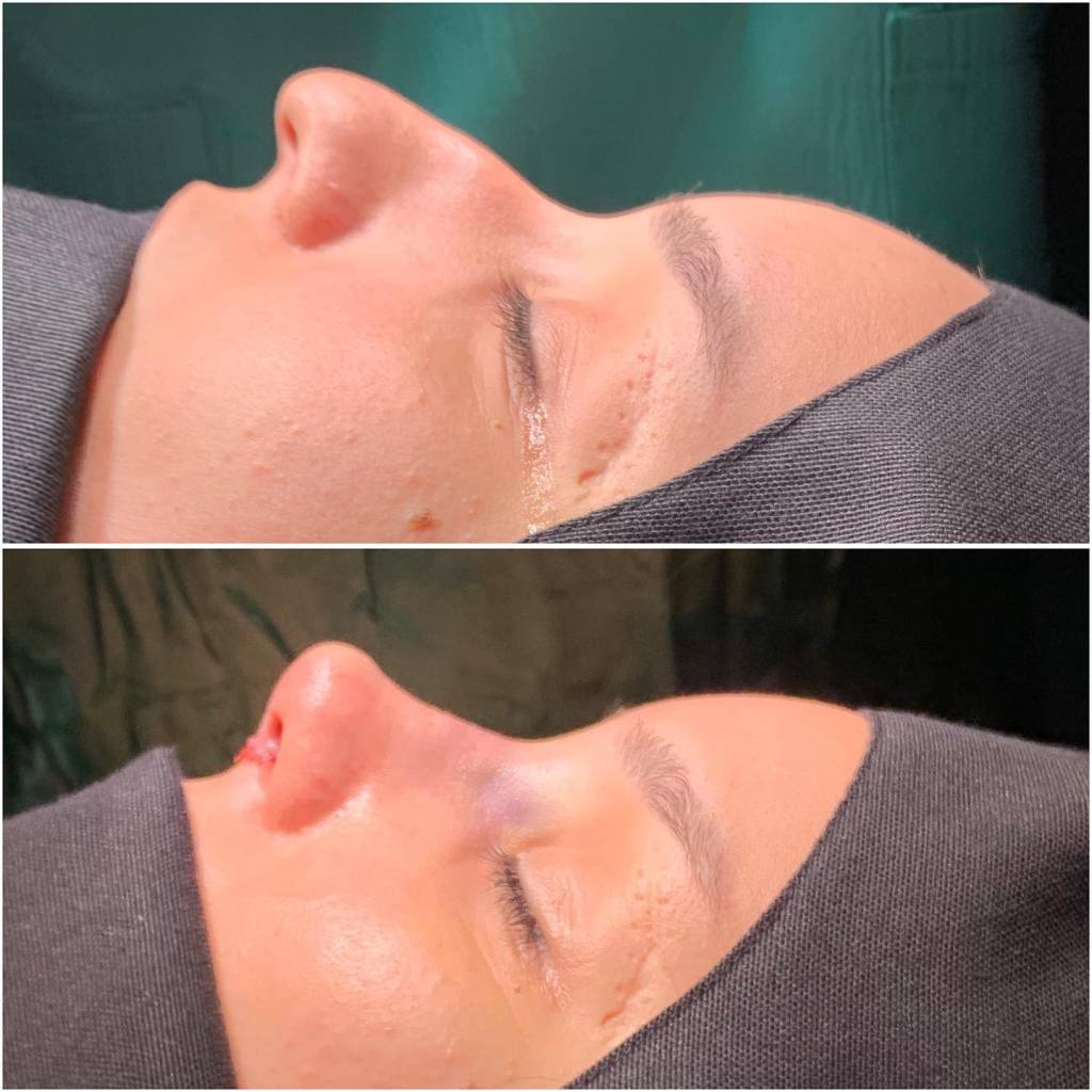 Affordable (Nose Job) Revision Rhinoplasty in Turkey 2026 - Görsel 4 - Prof. Dr. Baki Yılmaz