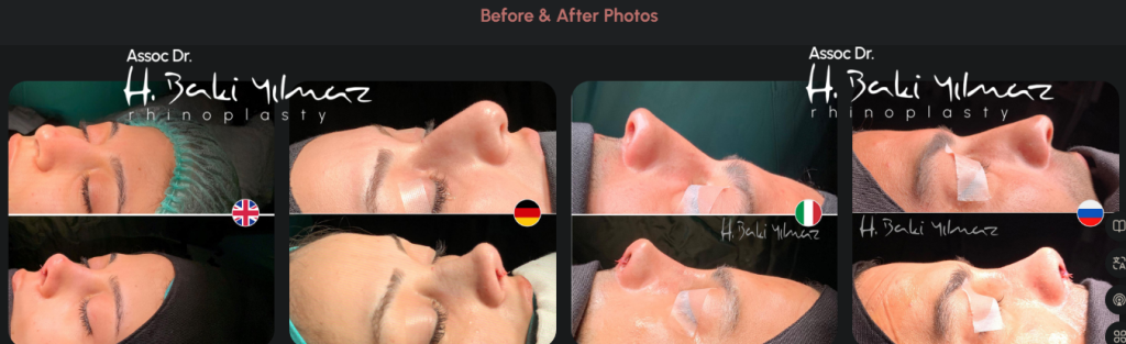 Turkey Rhinoplasty Package: Expert Surgeons & VIP Services - Görsel 3 - Prof. Dr. Baki Yılmaz