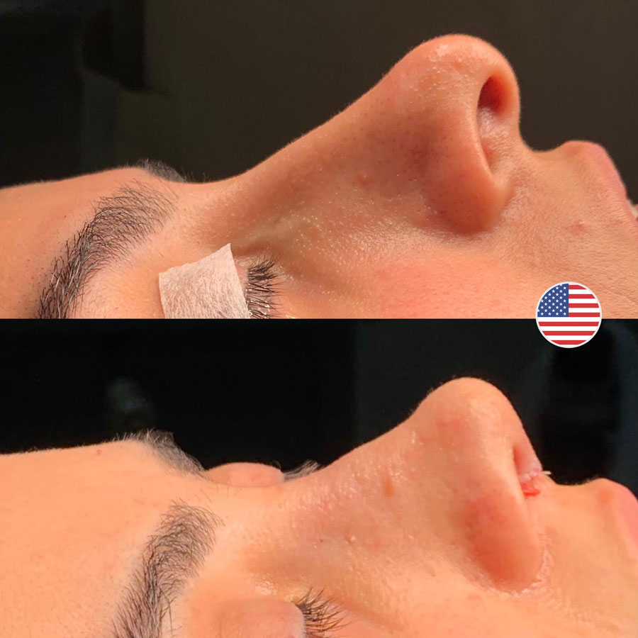 The Ultimate Rhinoplasty Healing Timeline: A Week-by-Week Guide - Görsel 2 - Prof. Dr. Baki Yılmaz