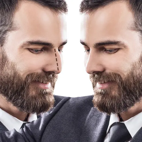 4-574b7b1e-3ae3-4bf8-abc0-d3610ad780fc — Männliche Rhinoplastik in der Türkei: Top Nasenoperation für Deutsche (2025)