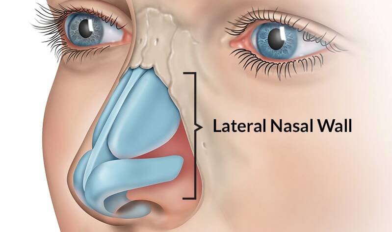 Nasal Valve Stenosis Symptoms and Surgery