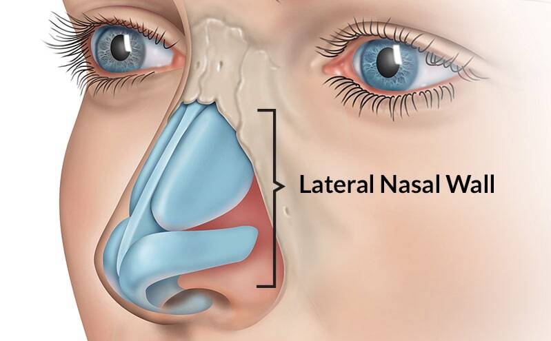 Nasal Valve Stenosis Symptoms and Surgery