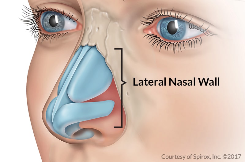 Nasal Valve Stenosis Symptoms and Surgery