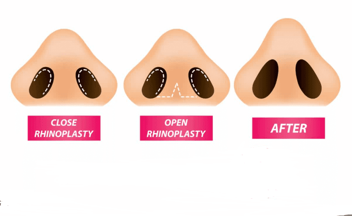 Screenshot_1 — Open vs. Closed Rhinoplasty: Which is Right for You? Expert Guide from Istanbul