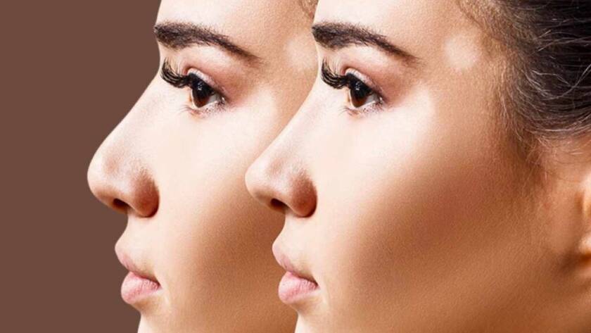 Vorher-Nachher Vergleich einer Nasenkorrektur (Rhinoplastik) im Seitenprofil. Das untere Bild zeigt das Ergebnis direkt nach der Operation mit sichtbaren Nähten. Patientin aus Deutschland. Dr. Baki Yılmaz