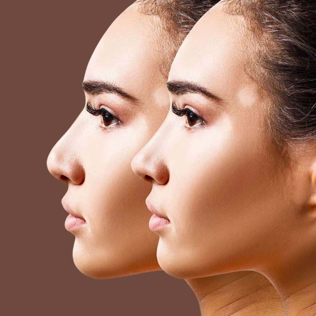 Vorher-Nachher Vergleich einer Nasenkorrektur (Rhinoplastik) im Seitenprofil. Das untere Bild zeigt das Ergebnis direkt nach der Operation mit sichtbaren Nähten. Patientin aus Deutschland. Dr. Baki Yılmaz
