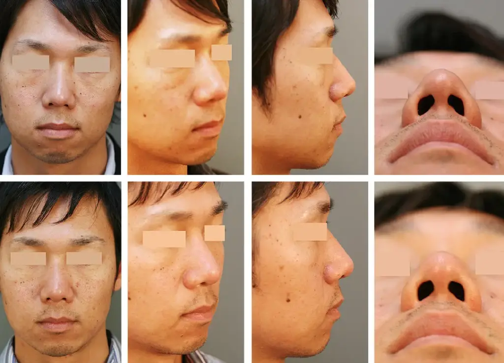 What is Ethnic Rhinoplasty?