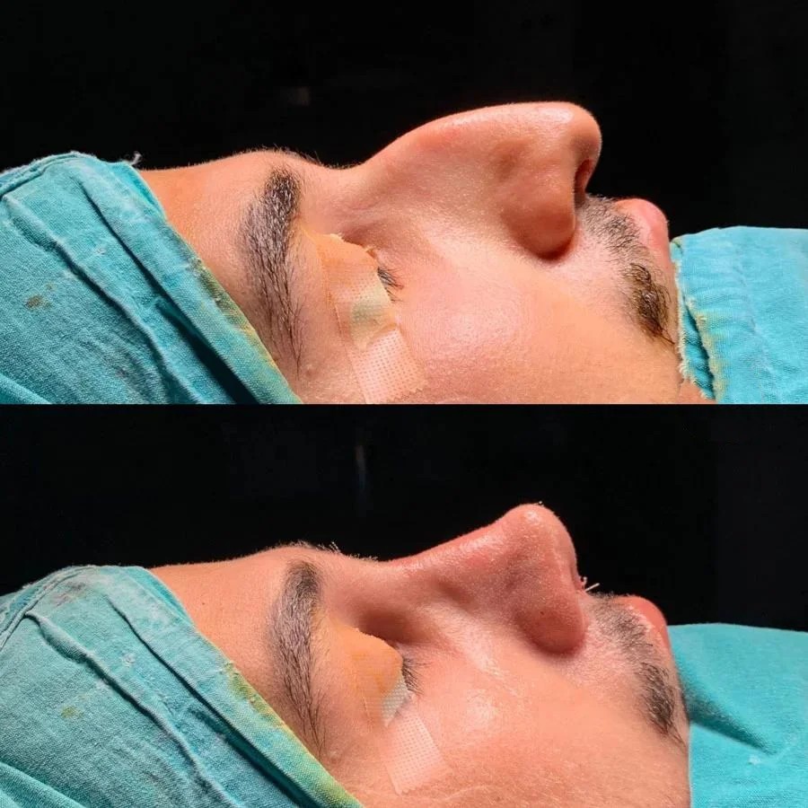 Beste Nasenkorrektur-Chirurgen in Europa - Dr. Baki Yilmaz Istanbul