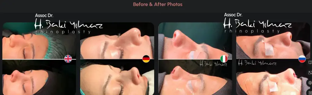 Piezo rhinoplasty for roman nose hump reduction without breaking the bone