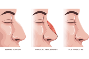 Phases of Rhinoplasty: Your Step-by-Step Healing Guide