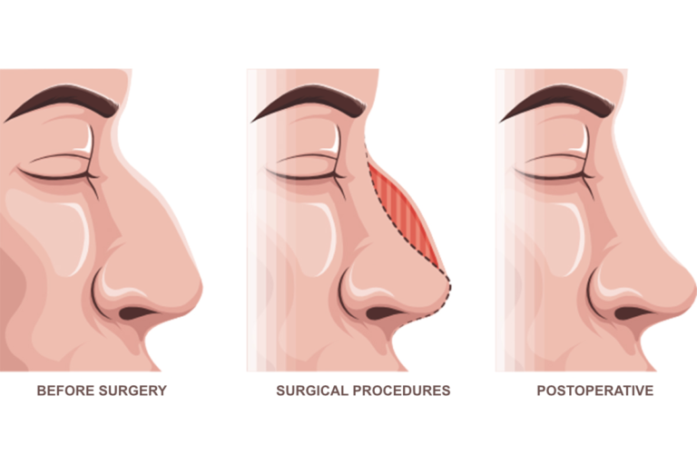 Phases of Rhinoplasty - Step by Step Recovery Journey