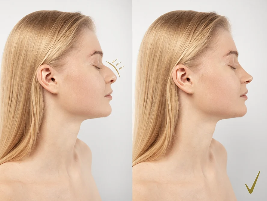 Nose Reduction Surgery Large Nose Turkey — Nose Reduction Surgery Large Nose Turkey: Istanbul Cost & VIP Guide 2026